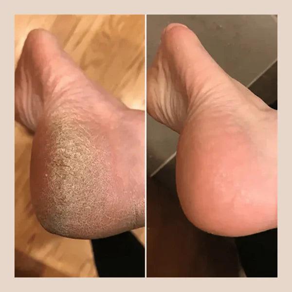 PedicurePro Lixador de Pés [Bônus] +Hidratante Grátis!